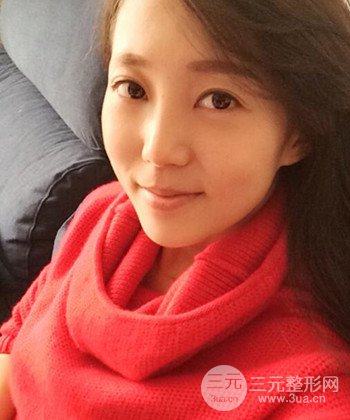 深圳內(nèi)切去眼袋+硅膠墊下巴真實(shí)案例恢復(fù)果圖