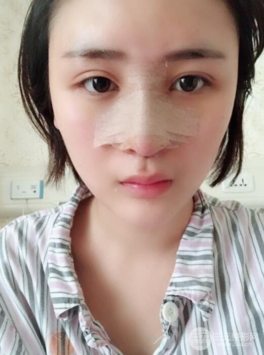 重慶五洲范文亮隆鼻整形案例，前后對(duì)比圖分享