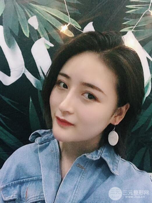 重慶五洲范文亮隆鼻整形案例，前后對(duì)比圖分享