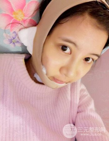 北京吸脂瘦臉真人案例恢復過程分享，巴掌小臉不是夢