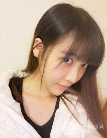 北京吸脂瘦臉真人案例恢復過程分享，巴掌小臉不是夢