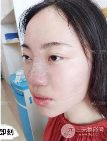 廣州博仕隆鼻失敗修復(fù)案例，前后恢復(fù)過(guò)程分享~