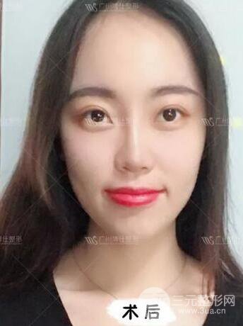 廣州博仕隆鼻失敗修復(fù)案例，前后恢復(fù)過(guò)程分享~