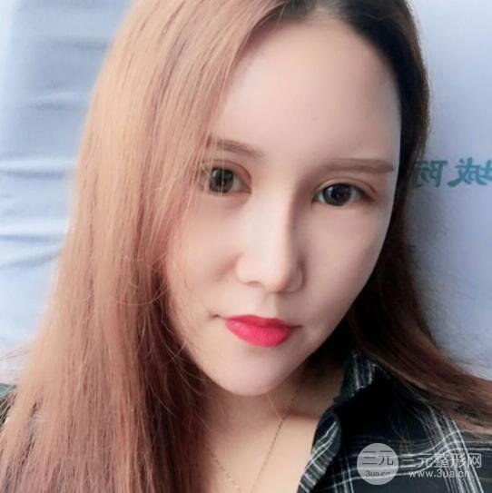 青島伊美爾國賓切開雙眼皮+隆鼻整形+硅膠墊下巴案例分享，附上前后對比照片