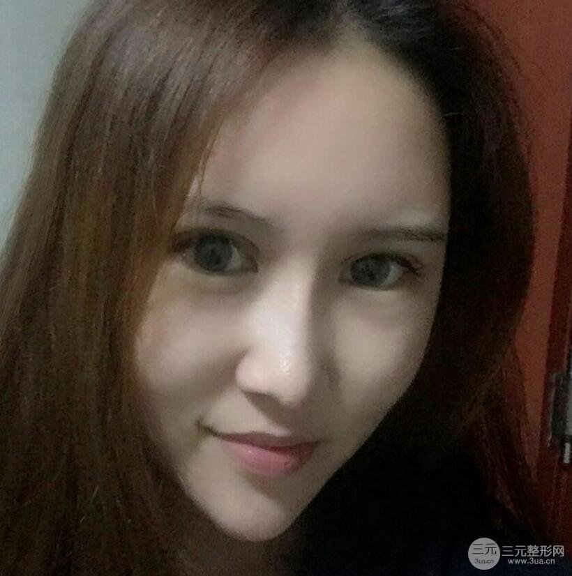 青島伊美爾國賓切開雙眼皮+隆鼻整形+硅膠墊下巴案例分享，附上前后對比照片