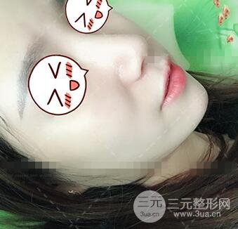 肖征剛做鼻子隆鼻案例恢復(fù)果圖日記