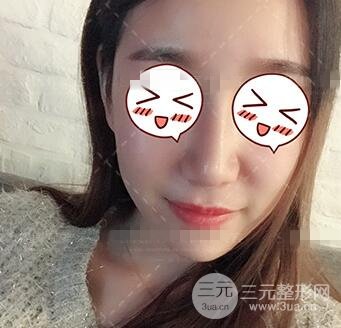 肖征剛做鼻子隆鼻案例恢復(fù)果圖日記