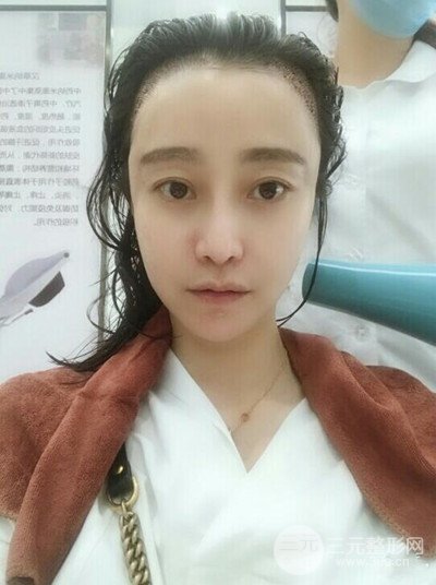 成都恒博發(fā)際線種植恢復(fù)過程分享