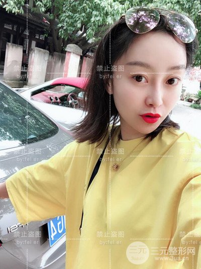 成都恒博發(fā)際線種植恢復(fù)過程分享