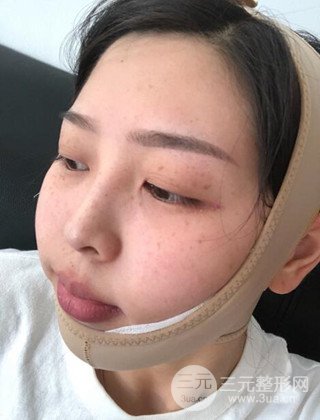 面部吸脂瘦臉手術(shù)日記分享，瘦臉果驚人