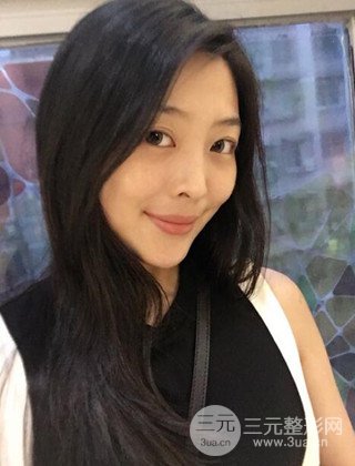 面部吸脂瘦臉手術(shù)日記分享，瘦臉果驚人