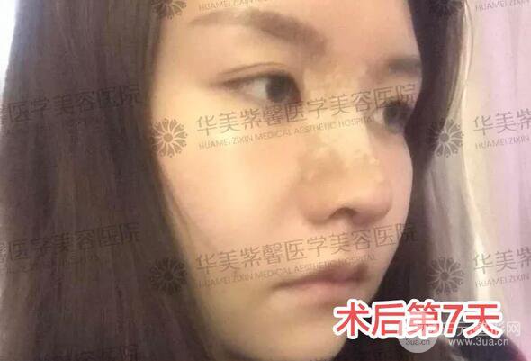 華美紫馨邱偉做的隆鼻術(shù)后10天驚人果分享！