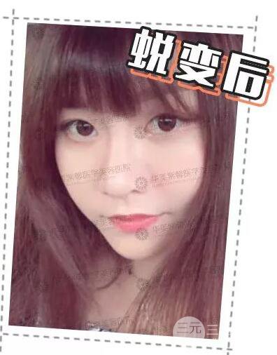 華美紫馨邱偉做的隆鼻術(shù)后10天驚人果分享！