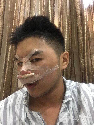 成都玉之光黃開亮醫(yī)生隆鼻修復(fù)整形案例，前后恢復(fù)過程分享