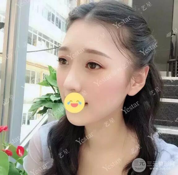 成都藝星6d明星眼雙眼皮術(shù)后恢復(fù)日記