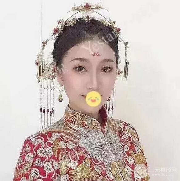 成都藝星6d明星眼雙眼皮術(shù)后恢復(fù)日記