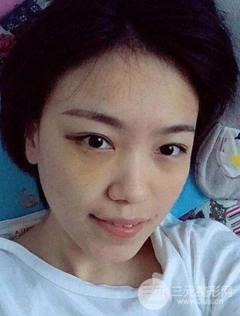 北京內(nèi)切祛眼袋真人案例果對比分享，年輕十歲不是夢