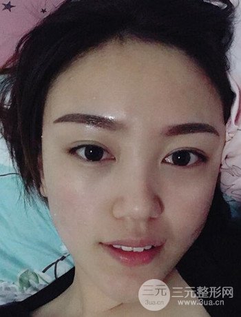 北京內(nèi)切祛眼袋真人案例果對比分享，年輕十歲不是夢