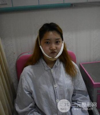 終于做了下頜角整形，分享術(shù)后恢復(fù)果
