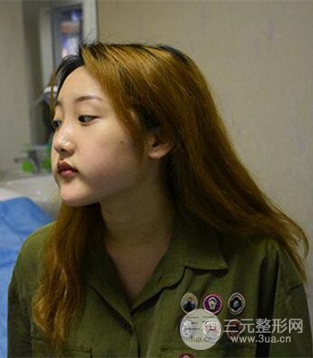 終于做了下頜角整形，分享術(shù)后恢復(fù)果