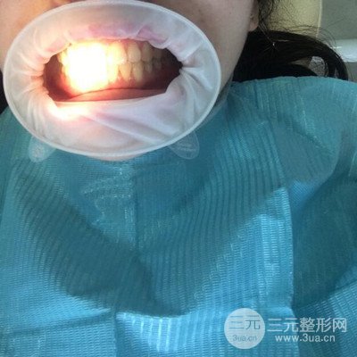 做了牙齒冷光美白果很棒，綻放美麗笑容