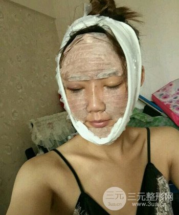 全臉自體脂肪填充手術(shù)日記分享，改良臉型年輕十歲