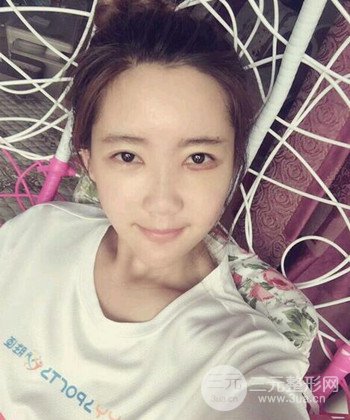 全臉自體脂肪填充手術(shù)日記分享，改良臉型年輕十歲