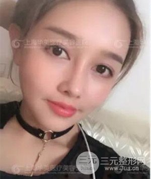 隆鼻失敗修復(fù)+詳細(xì)部自體脂肪填充案例分享，上海華美做的!