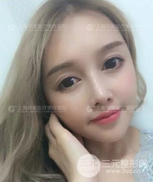 隆鼻失敗修復(fù)+詳細(xì)部自體脂肪填充案例分享，上海華美做的!
