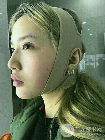 大圓臉做了面部吸脂瘦臉果很棒，立現(xiàn)漂亮鵝蛋臉