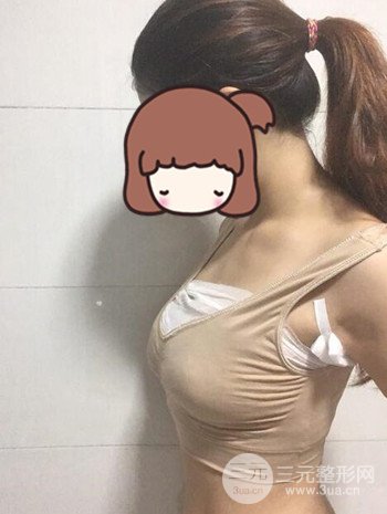 假體隆胸術(shù)后成功擺脫小學(xué)生身材，立現(xiàn)性感身材