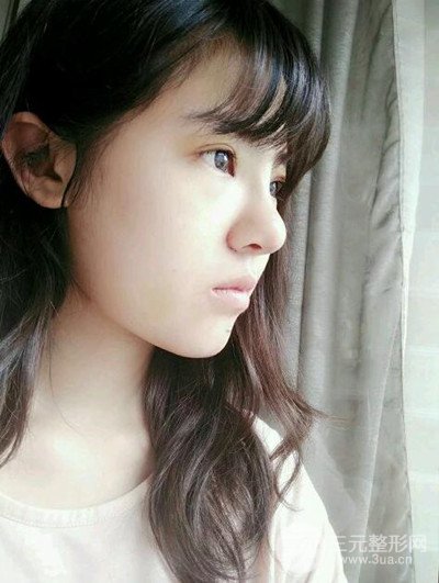 廣州美萊李高峰隆鼻整形案例前后對比圖分享~