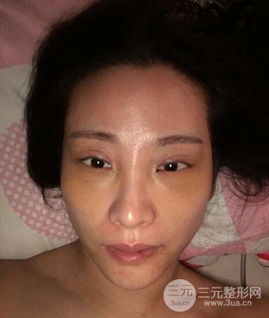 內(nèi)切微創(chuàng)去眼袋手術(shù)案例分享，附上手術(shù)恢復(fù)照片