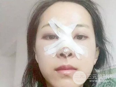 長(zhǎng)沙鵬愛(ài)彭正春假體隆鼻案例分享