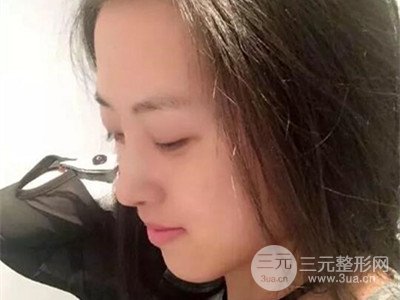 長(zhǎng)沙鵬愛(ài)彭正春假體隆鼻案例分享