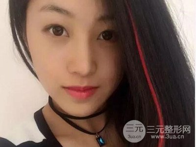 長(zhǎng)沙鵬愛(ài)彭正春假體隆鼻案例分享