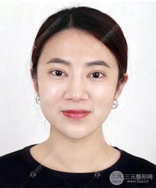 沈陽(yáng)百嘉麗雙眼皮+開(kāi)眼角恢復(fù)日記以及前后對(duì)比圖分享~