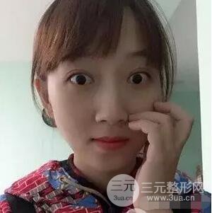 吉林銘醫(yī)李紅雙眼皮修復(fù)前后對(duì)比圖 內(nèi)附吉林銘醫(yī)小彩蛋哦