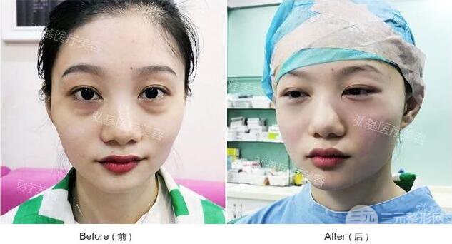 廣州弘基醫(yī)療美容祛眼袋案例,看看她是怎么變美的！
