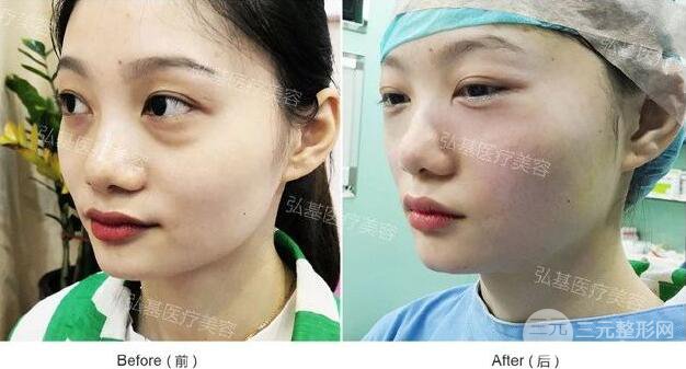 廣州弘基醫(yī)療美容祛眼袋案例,看看她是怎么變美的！