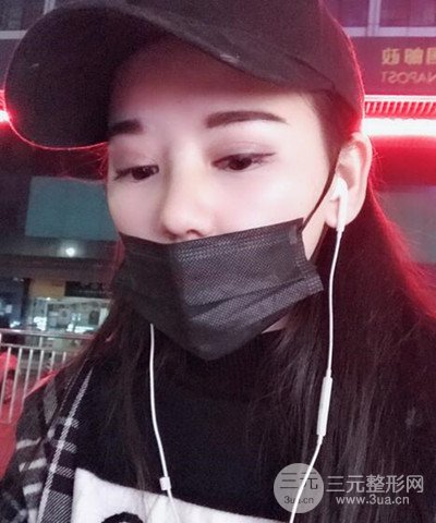 做了隆鼻整形成功落實精致小巧鼻 附上果圖