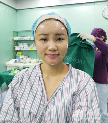 廣州弘基醫(yī)療美容自體脂肪填充案例