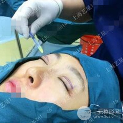 上海藝星雙眼皮日記分享，割雙眼皮后大變樣！
