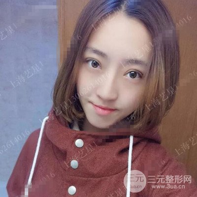 上海藝星雙眼皮日記分享，割雙眼皮后大變樣！