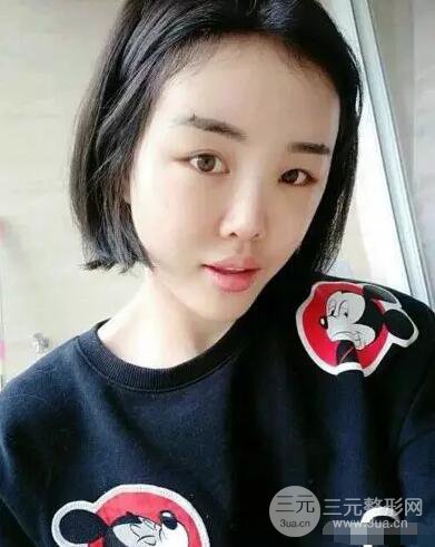 成都玉之光自體脂肪面部填充劉中國真人案例反饋|內附對比前后照