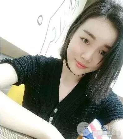 成都玉之光自體脂肪面部填充劉中國真人案例反饋|內附對比前后照