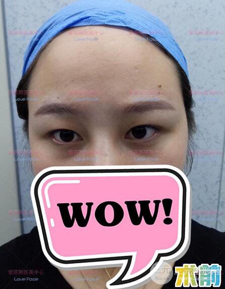 揚(yáng)州艾菲斯黃嬋院長(zhǎng)雙眼皮案例術(shù)后七天果