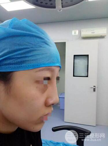 揚(yáng)州艾菲斯整形隆鼻案例，自拍盛顏不是夢(mèng)！