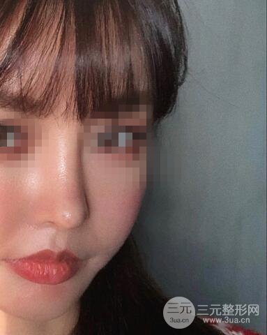 揚(yáng)州艾菲斯整形隆鼻案例，自拍盛顏不是夢(mèng)！