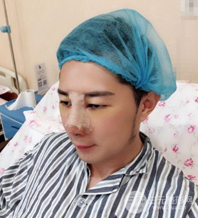 肋軟骨隆鼻整形案例分享，在深圳雅涵做的!